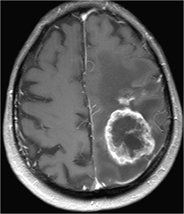 Brain Tumour Brain Tumour