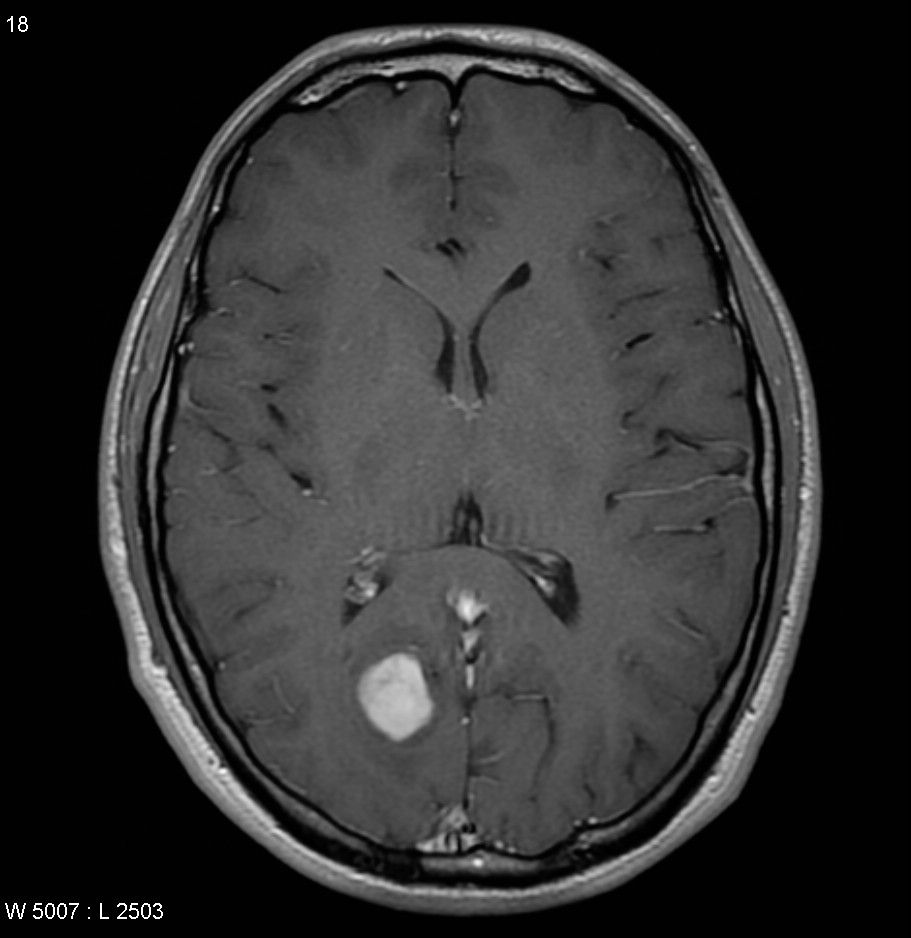 Brain Tumour Brain Tumour