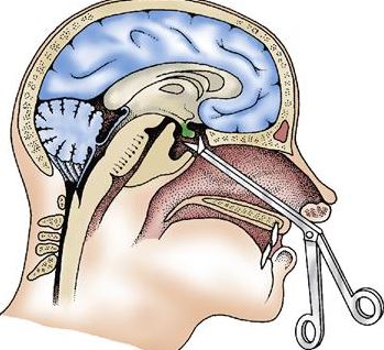 brain tumor treatment Hong Kong