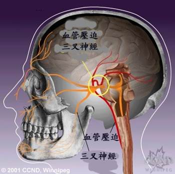 血管壓迫三叉神經 血管壓迫三叉神經