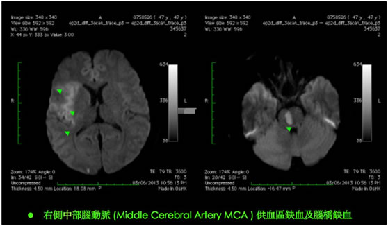 腦內血管介入微創手術