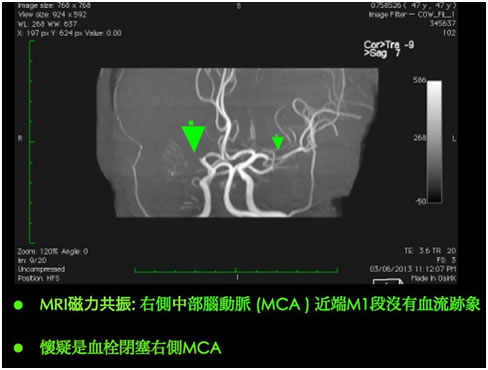 血栓閉塞右側MCA