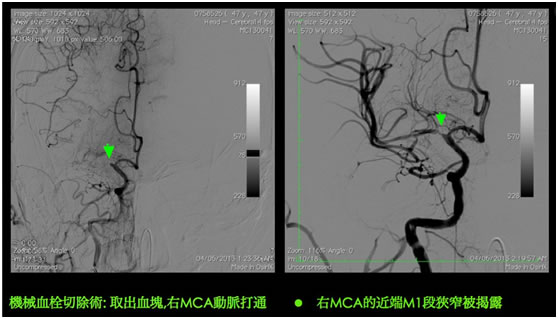 middle-cerebral-artery-MCA4