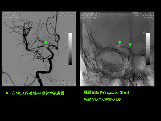 middle-cerebral-artery-MCA5