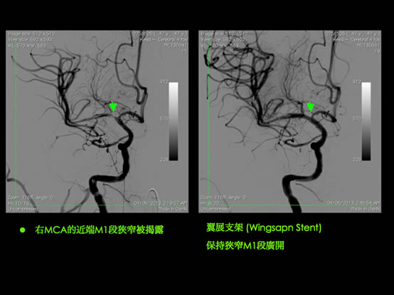 middle-cerebral-artery-MCA6