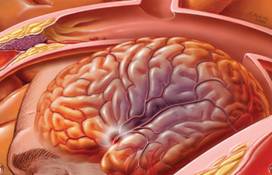 Pro-active Treatment