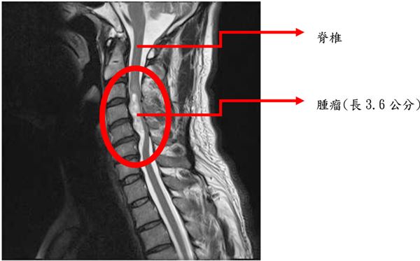 MRI下脊椎內腫瘤