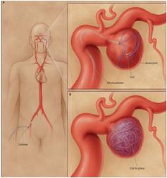 Stroke Risk Screening