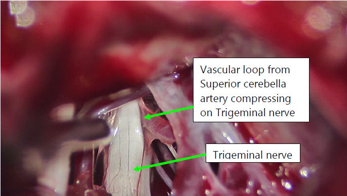 Trigeminal Nerve