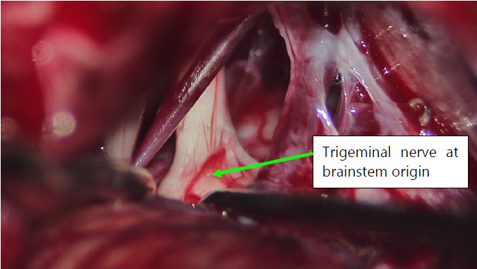 Trigeminal Nerve