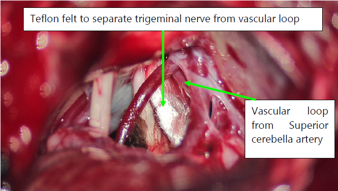 Trigeminal Nerve